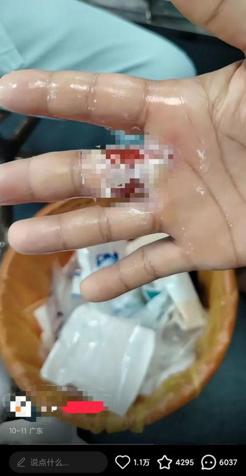 手指受伤的照片,揭秘手指受伤的康复之路